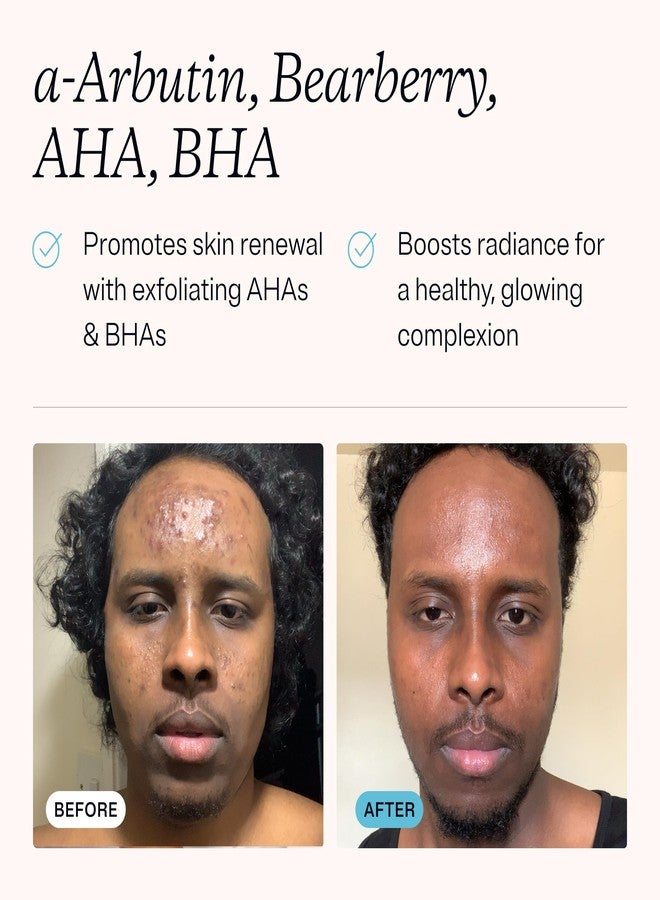 إم دي أكني مزيل البقع الداكنة MDacne للوجه والجسم، 40 مل (عبوة من 3 قطع) - يحسن إشراقة البشرة وملمسها ولونها، خالٍ من الزيوت للبشرة الحساسة والمعرضة لحب الشباب، أحماض ألفا هيدروكسي وبيتا هيدروكسي تعزز نضارة البشرة، تركيبة من أطباء الجلدية - Image 3